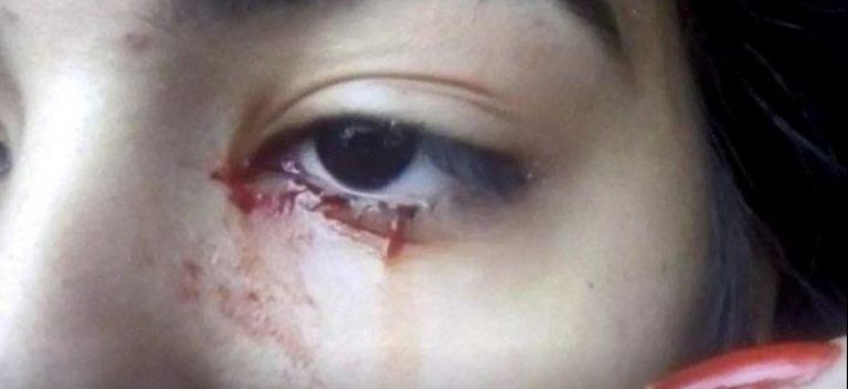 Remaja Perempuan Dilapor Keluarkan Air Mata Darah Setiap Remaja Perempuan Dilapor Keluarkan Air Mata Darah Setiap