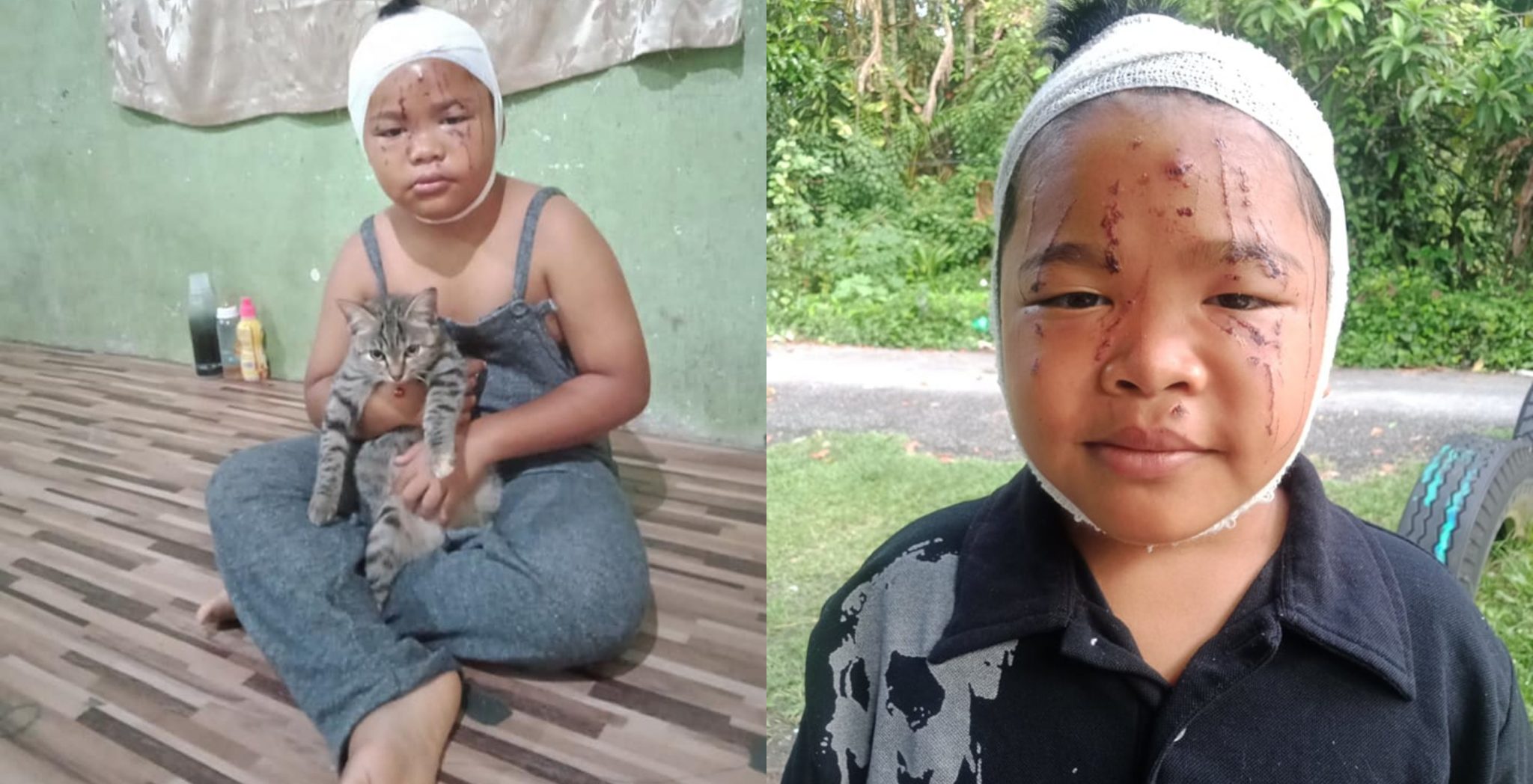Walau Muka Luka Teruk Dicakar, Ibu Dedah Anak Tetap Sayang & Nak Bela