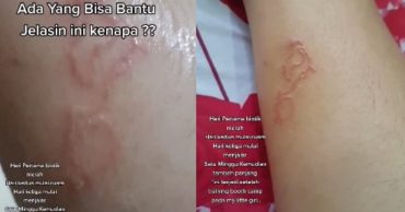 (Video) Ketahui 'Creeping Eruption' Yang Disebabkan Oleh ...