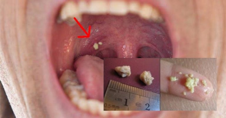 “Awas, Jangan Buang Dengan...”, Bau Busuk, Apa Sebenarnya Ketulan Putih