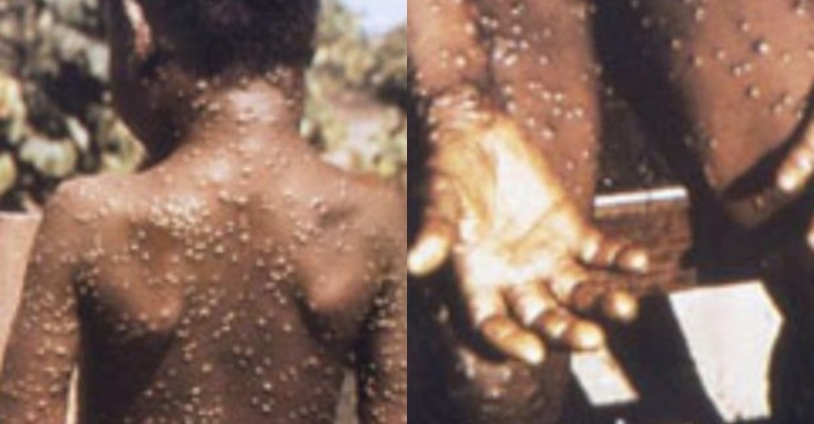 Monkeypox