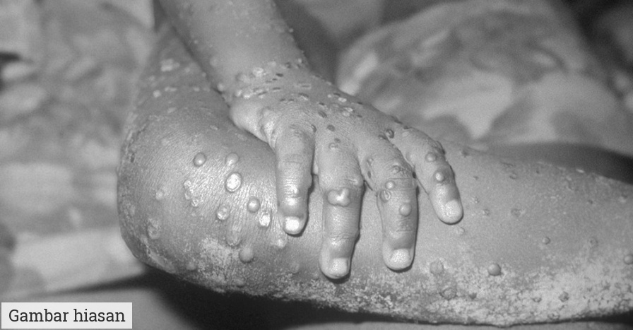 kes pertama monkeypox