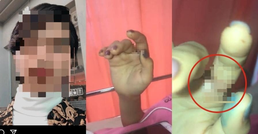 wanita hampir putus jari