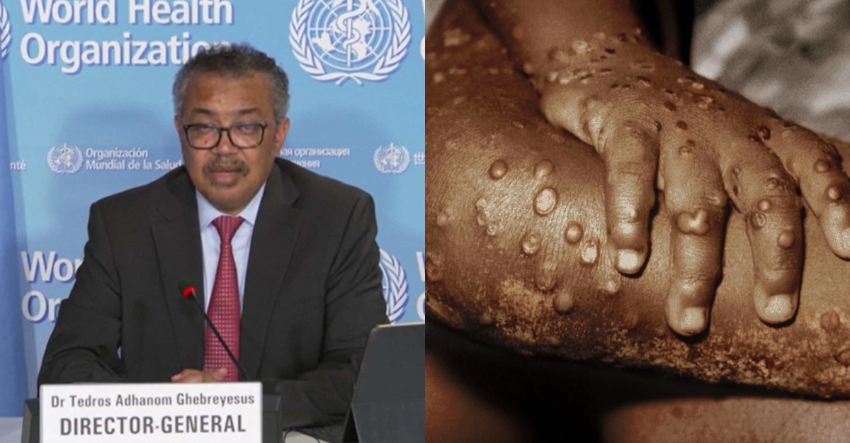 who isytihar monkeypox kecemasan global