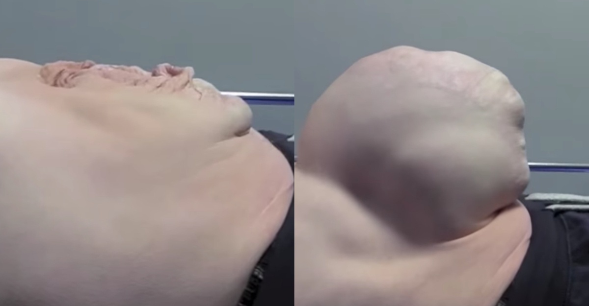 hernia sebesar bola