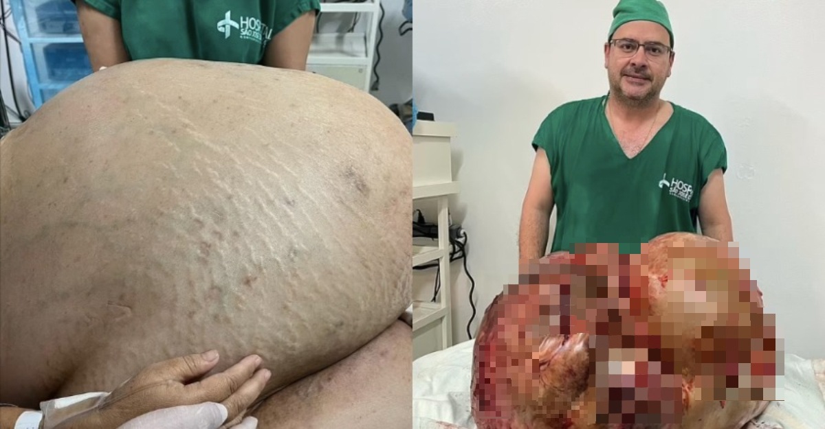 Keluarkan Ketumbuhan Seberat 45Kg