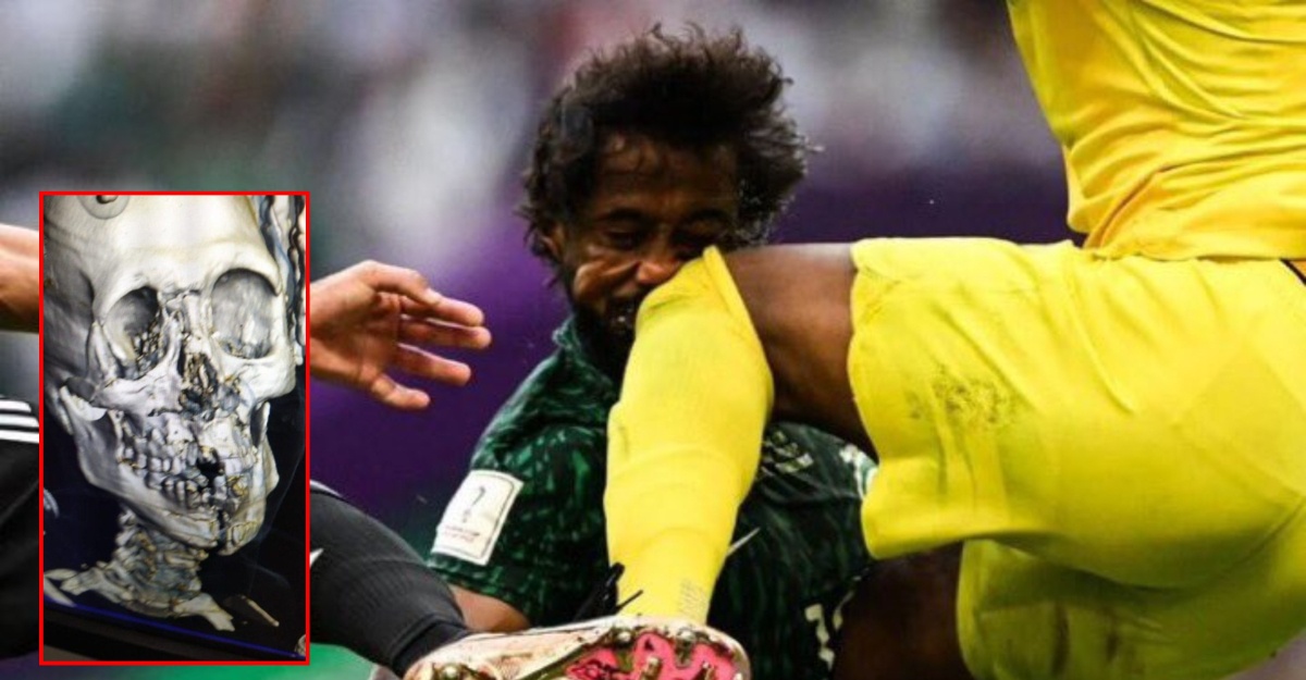 yasser alami patah rahang