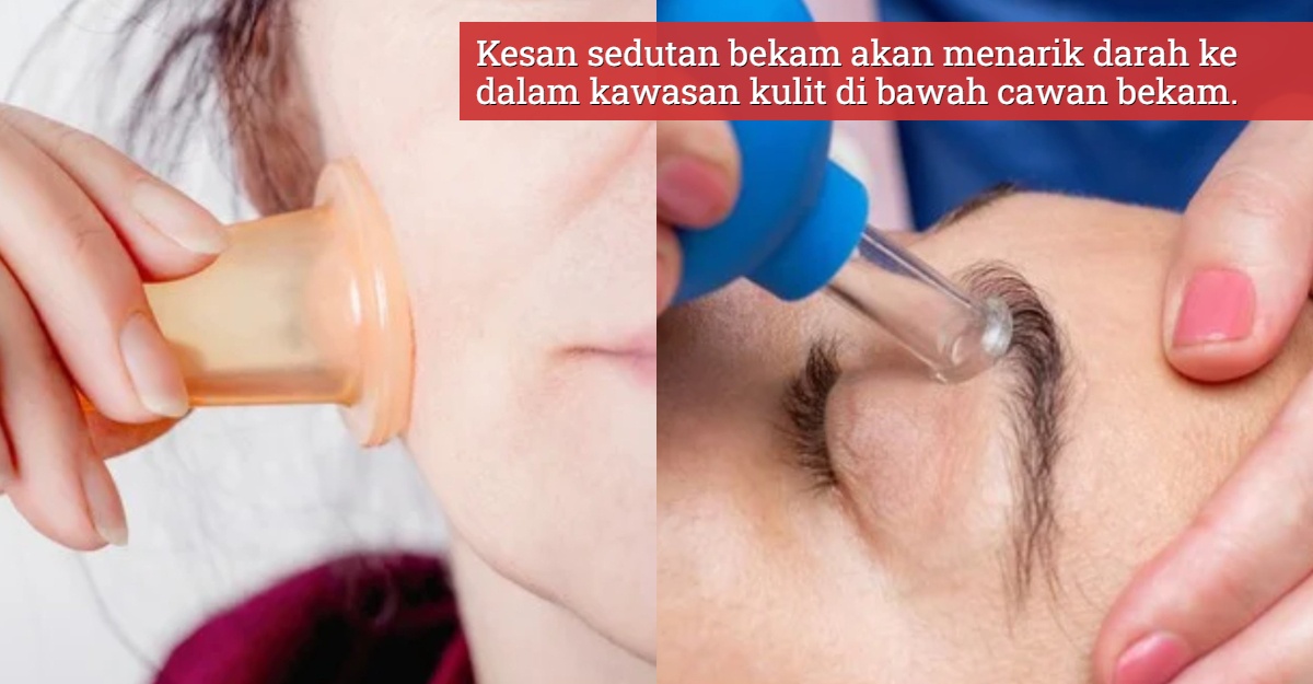 bekam muka