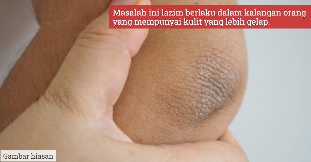 cara bersihkan siku hitam