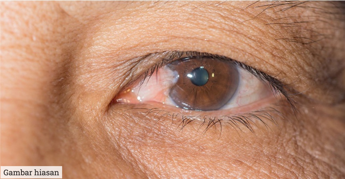 apa itu pterygium