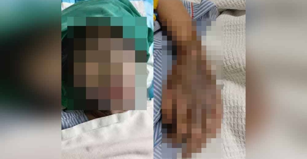 Bapa Zahir Rasa Terkilan, Anak Perempuan Alami Kesan Melecur Teruk Akibat Disimbah Asid Bapa menzahirkan rasa terkilan apabila anak perempuan mengalami kesan melecur pada bahagian muka akibat disimbah asid pada awal bulan lepas.