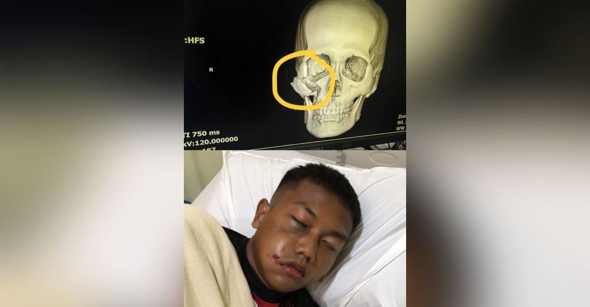 Johan Shahzidane Patah Tulang Pipi