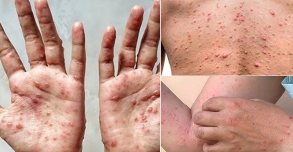 mpox kes baharu
