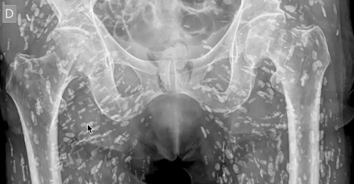 X-ray ratusan bintik putih