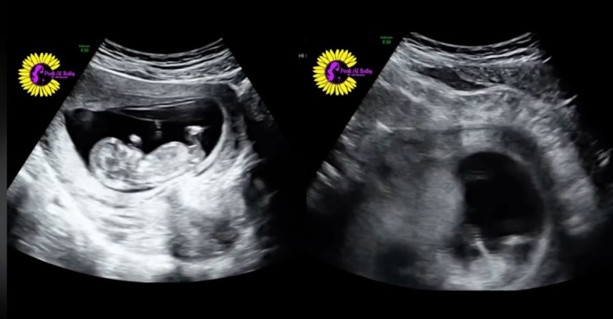 Bayi Dalam Kandungan